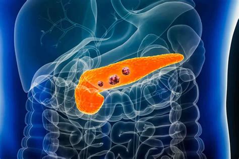 Tumore Al Pancreas Come Riconoscerlo In Anticipo