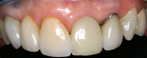 Porcelain Fused To Metal Crown Before And After