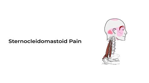 Sternocleidomastoid Pain ~ Stat Cardiologist