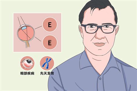 屈光参差 有来医生