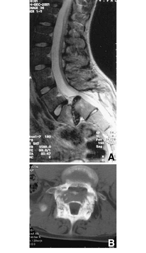 Sagittal Magnetic Resonance Image A And Axial Computed Tomography Download Scientific Diagram