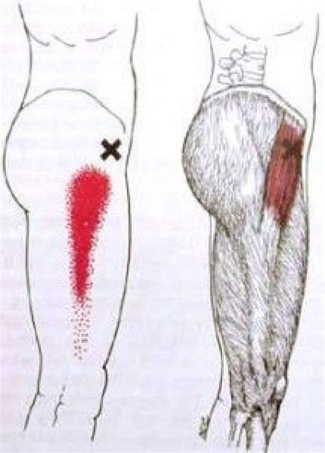 Know Your Trigger Point Muscle Series Tensor Fasciae Latae Psoastriggerpoints Hip Flexor Pain