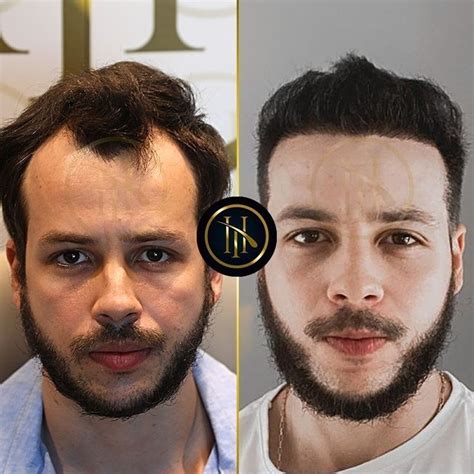 Hair Transplant Before And After Trasplante De Cabello Cabello Rapados