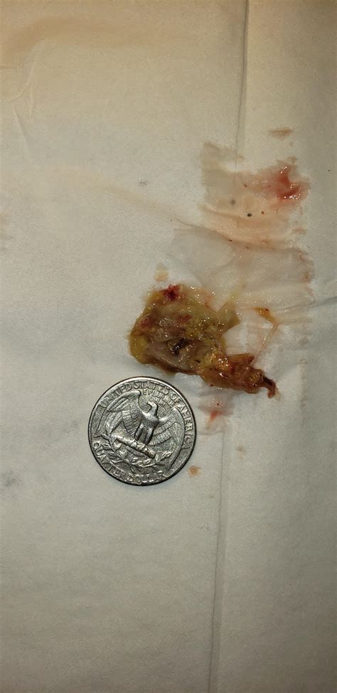 By far the most satisfying booger I blown out since being here ...