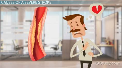 What is a Massive Stroke? - Causes & Symptoms - Lesson | Study.com