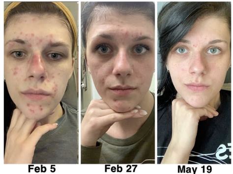 How Much Time Does It Take For Pih Post Inflamatory Hyperpigmentation