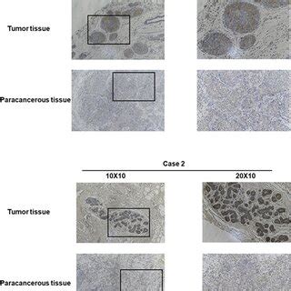 Representative Images Of Cenpn Expression In Breast Cancer Tissues And