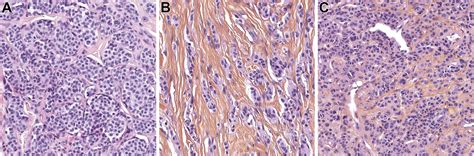 Spectrum Of Melanocytic Tumors Harboring Braf Gene Fusions 58 Cases With Histomorphologic And