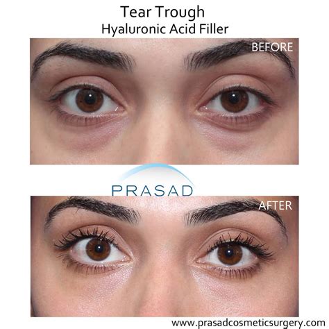 Injections For Dark Circles