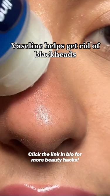 Vaseline Hack That Gets Rid Of Blackheads Blackheads Skin Care