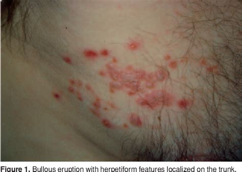 Figure From Linear Immunoglobulin A Bullous Dermatosis Induced By