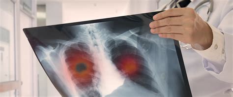 Understanding The Risk Of Mesothelioma From Previous Lung Conditions