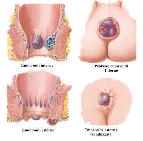 Le Emorroidi Cosa Sono E Come Si Curano Dr Niccol Ghezzi