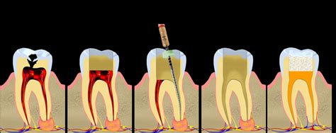 Endodoncia Oralcorp Loja Especialidades Odontol Gicas