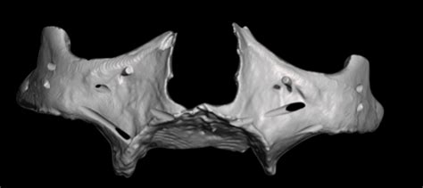 Zygoma Fracture During Zygomatic Implant Installation