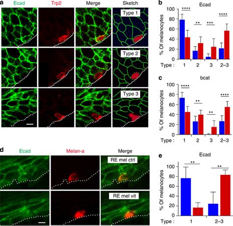 E Cadherin Ecad Staining Is Altered In Vitiligo Melanocytes A