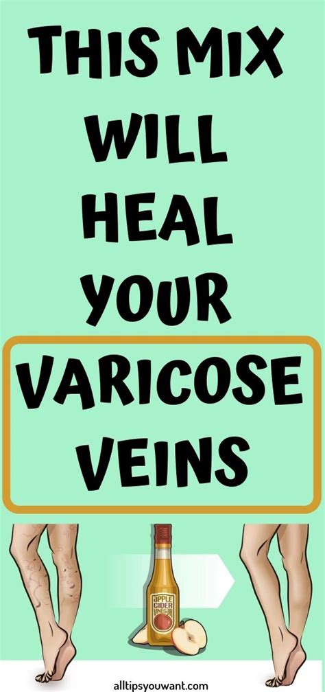 This Mix Will Heal Your Varicose Veins Varicose Vein Remedy Varicose