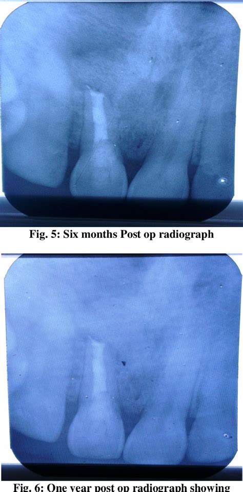 Figure 1 From Management Of A Large Non Healing Periapical Lesion By