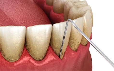 Gum Recession Treatment From A Periodontist Prosoft Implantology