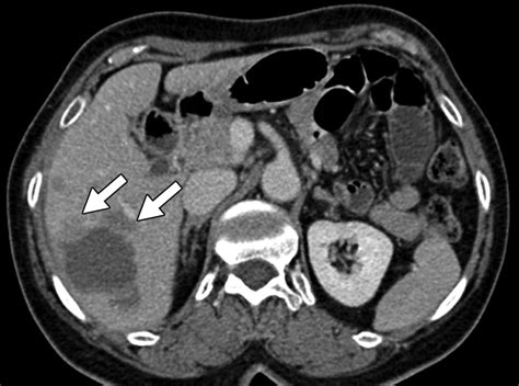 Volumetric Arterial Enhancement Fraction Predicts Tumor Recurrence