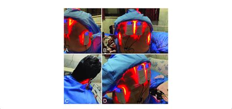 | Illustrations of the positioning of the Photobiomodulation devices on ...