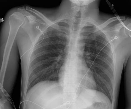 Normal Anterior Posterior Chest Radiograph Radiology Case