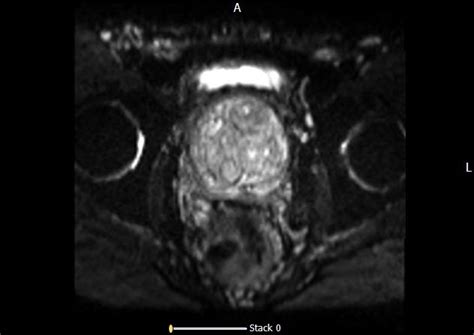 Prostate Mri Maryland Radiologist Charter Radiology