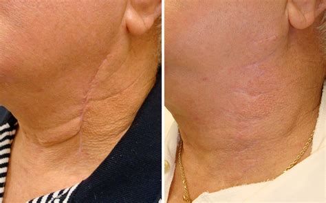 Scar Removal In Scottsdale