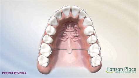 Trans Palatal Arch Youtube