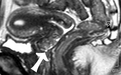 MR Imaging Of The Uterine Cervix Imaging Pathologic Correlation