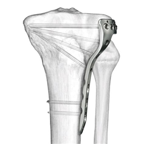 Mm Va Lcp Proximal Tibia Plate Welcome To Sys Medtech