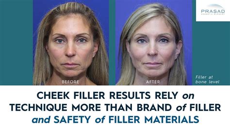 Cheek Filler Before and After, and What You Need to Know