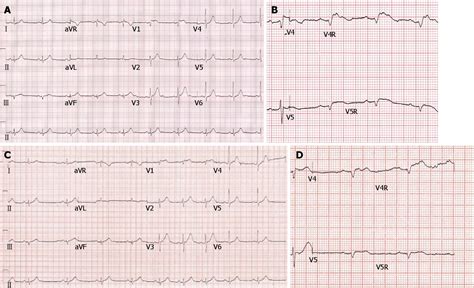 Figure 1 From Primary Angioplasty For Infarction Due To Isolated Right