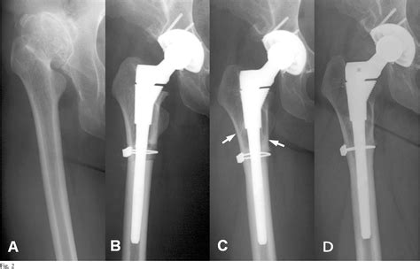 Figure 2 From Cementless Modular Total Hip Arthroplasty With