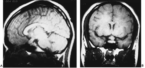 ON - RADIOLOGY: Optic nerve glioma; the most common cause of optic nerve thickening