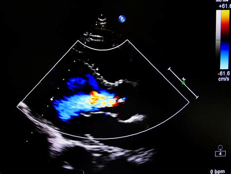 2 D Echocardiogram Springfield Arlington Va Cardiologist