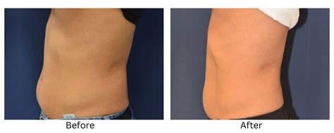 Trusculpt Before And After Results Fat Reduction And Muscle Sculpting