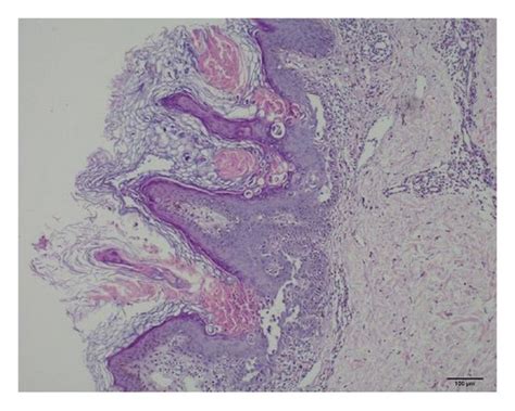 Skin Biopsy Showing Hyperkeratosis Dyskeratosis Papillomatosis