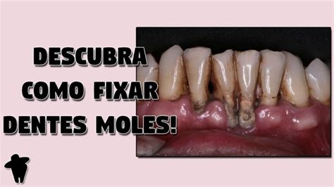 Descubra Como Recuperar Um Dente Mole De Forma Eficiente Actualizado