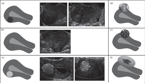 Terms Definitions And Measurements To Describe Sonographic Features Of