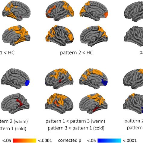 Cortical Atrophy Patterns At Cluster Level A Color Maps Indicate