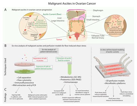 Cancers Free Full Text Malignant Ascites In Ovarian Cancer