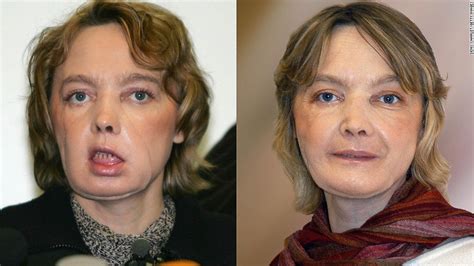 World's first face transplant patient dies at age 49 - JEJEUPDATES.COM