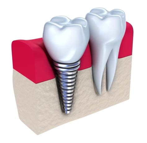 The Benefits Of Dental Implants In Chapel Hill NC