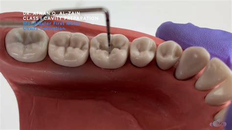 Class I Cavity Preparation For Composite Mandibular Molar