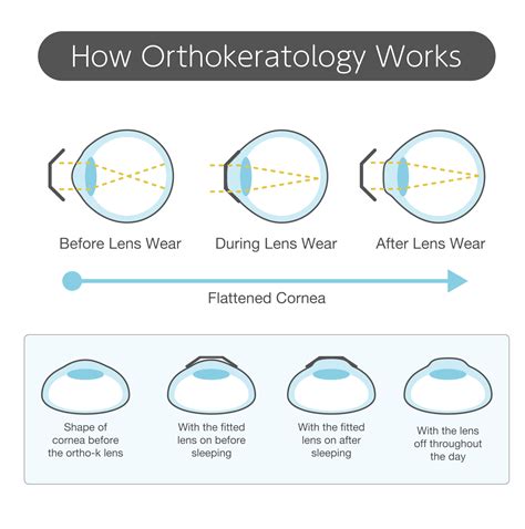 Orthokeratology Scott Eye Care