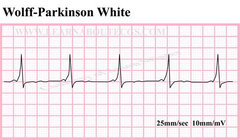 WPW ECG Rhythm Strip by ELECTROCARDIOLOGY on Etsy