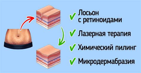Что такое растяжки и как от них избавиться / Бери и делай