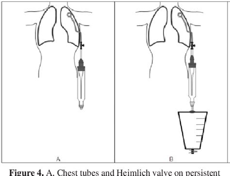 Figure From Heimlich Valve As An Ambulation Management Of Persistent