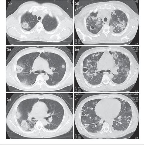 Figure 1 From Reversed Halo Sign Caused By Huge Tricuspid Native Valve Infective Endocarditis